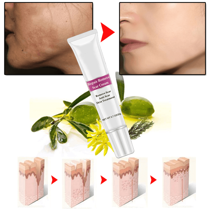 Rtopr Facial Body Scar Removal Cream Repair Skin Weaken Marks Eliminate Pimple Promote Horny Layer Updating - Trendha