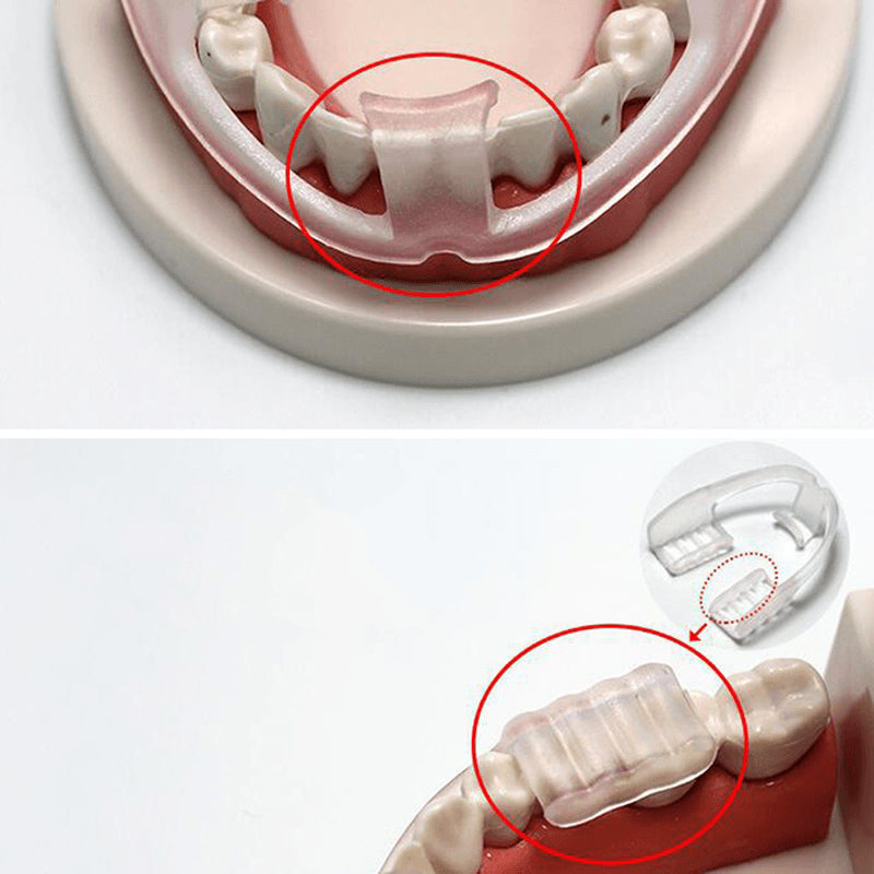 Molar Pads Anti-Grinding Orthodontic Brace Sleeping Wear-Resistant Teeth Braces Health Teeth Care Dental Tools - Trendha