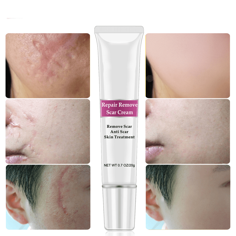 Rtopr Facial Body Scar Removal Cream Repair Skin Weaken Marks Eliminate Pimple Promote Horny Layer Updating - Trendha